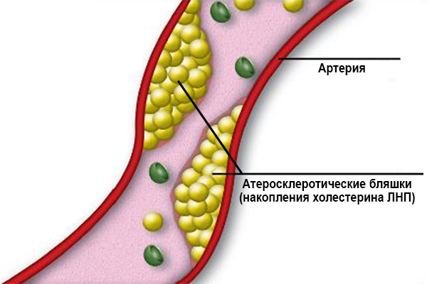 Атеросклеротические бляшки (накопления холестерина ЛНП)