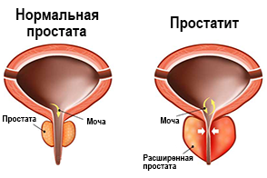 Нормальная простата и простатит