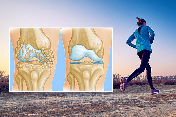 Остеоартроз коленного сустава и бег от него