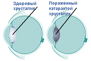 Схема здорового и поражённого катарактой хурсталика