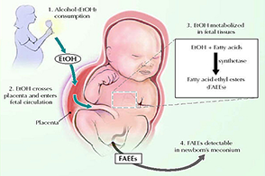 Схема развития эмбрионального алкогольного синдрома