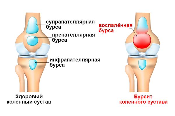 Здоровое колено и бурсит коленного сустава
