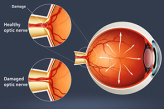 Глаукома и повреждение оптического нерва