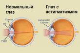 Нормальный глаз и астигматизм