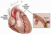 Схема ишемической болезни сердца